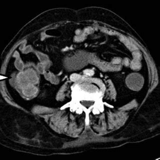 Contrast Enhanced Computed Tomography Of The Abdomen Showing Dilated