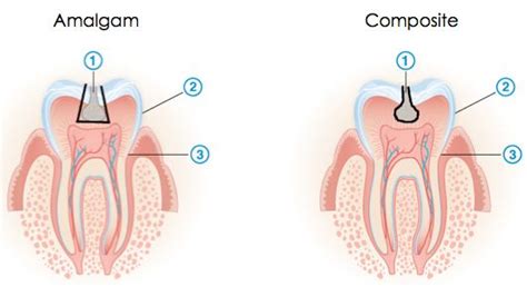 Amalgam-vs-Composite | Dental assistant study, How to prevent cavities ...