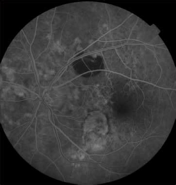 Improving Differential Diagnosis of Angioid Streaks | Retinal Physician