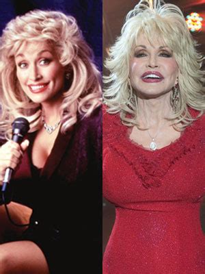 Dolly Parton Before And After Weight Loss