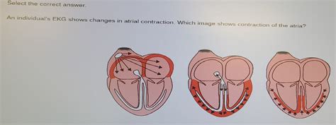 Select The Correct Answer An Individual S Ekg Shows Changes In Atrial