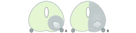 The Different Ablation Treatments A Focal Ablation Of A Pca Lesion In