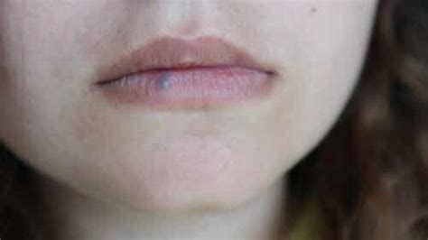 Lip cancer: causes, symptoms and treatments