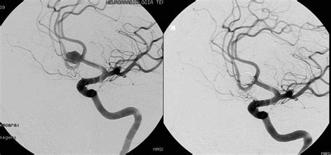 Pruebas Dx Para Que Sirve Una Angiograf A Cerebral