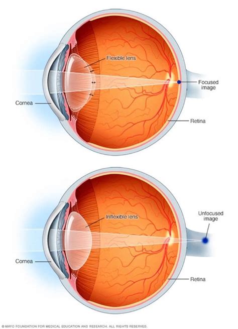 Presbyopia Grace And Vision Optometrist Brisbane