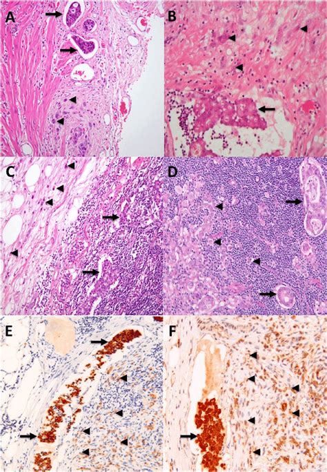 Hematoxylin And Eosin Stained Section Of Primary Gastric Carcinoma A Download Scientific