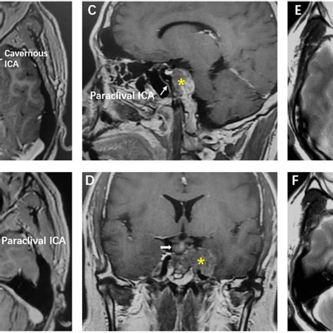 Preoperative magnetic resonance imaging (MRI) demonstrated a tumor mass ...