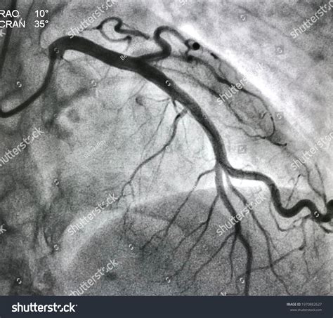 Angiogram Images, Stock Photos & Vectors | Shutterstock