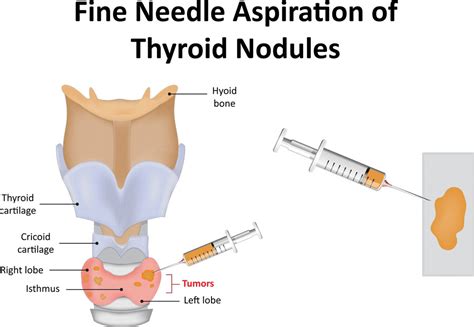 Fine Needle Aspiration Of Thyroid Nodules Otolaryngology Specialists Of North Texas