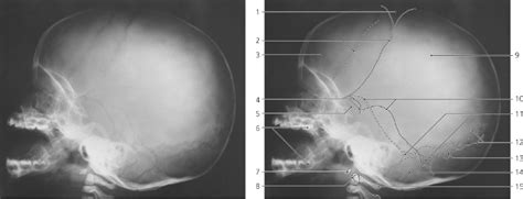 Lambdoid Suture X Ray