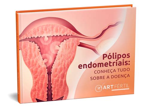 P Lipos Endometriais Conhe A Tudo Sobre A Doen A Art F Rtil