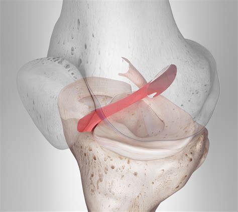 Preguntas Clave Sobre El Ligamento Cruzado Anterior