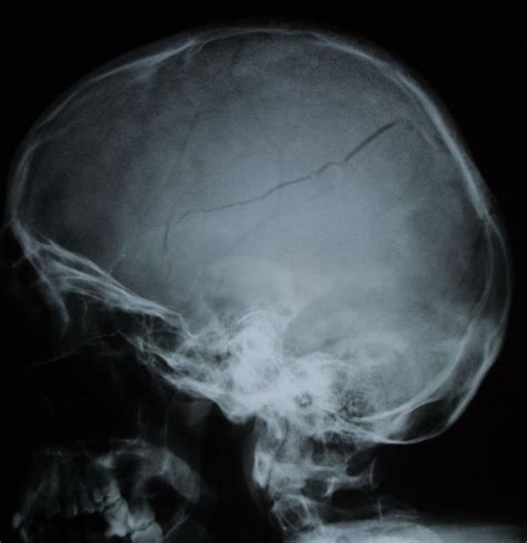 X Ray Of Skull Fracture Images