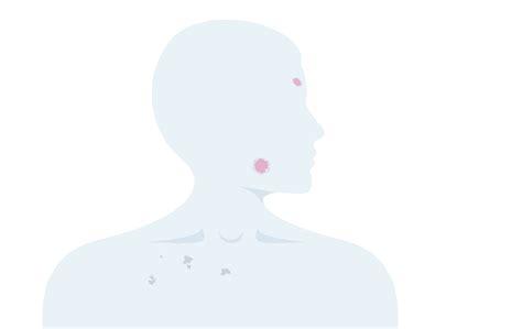 Statistik malignt melanom i huden – dödlighet & överlevnad | Cancerfonden