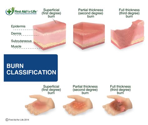 Burn Severity Chart