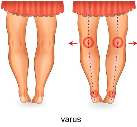 What Is Overpronation Overpronation Flat Feet Pain And How To Fix It