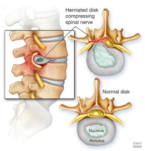 Essentials Of A Disc Herniation And Bulging Discs Physiotherapists In Toronto Yorkville Sports