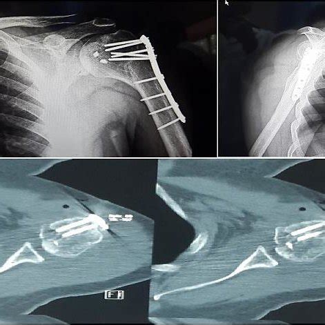 Shoulder range of motion (ROM) examination one month after the revision ...