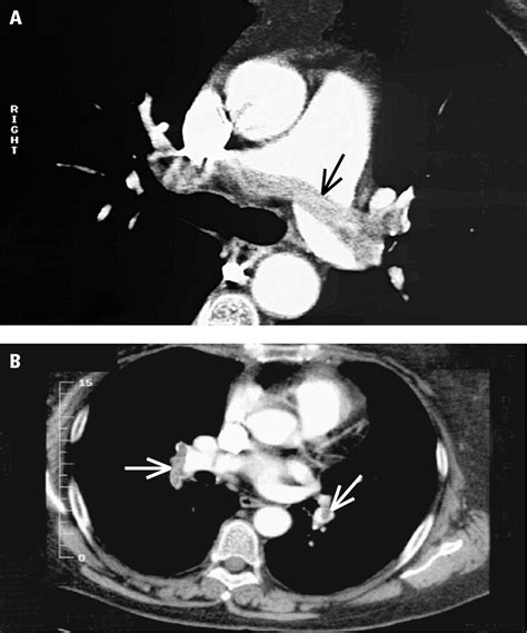 Figure Computed Tomography Angiography Cta Of Pulmonary