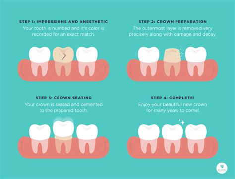 Everything You Need To Know About Dental Crowns