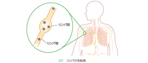 Q4肺がんが転移しやすい場所と症状について教えてください