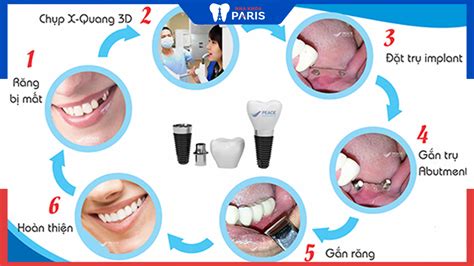 Quy trình cấy ghép răng Implant thực hiện như thế nào Nha khoa Paris