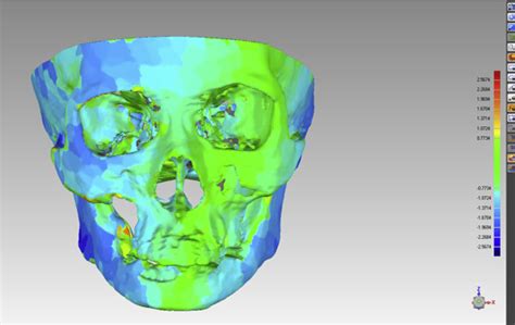 Three Dimensional Image Fusion Of F Fluorodeoxyglucosepositron