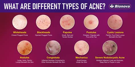 Acne Types Causes And Effective Treatment For Acne Free Skin