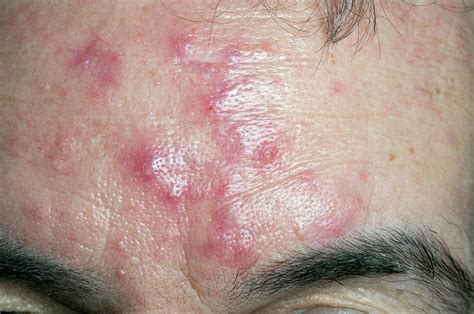 Acne Rosacea On The Forehead Photograph By Dr P Marazziscience Photo Library