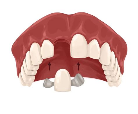 Dental Bridges In London Tooth Replacement Holland Park Dental Centre