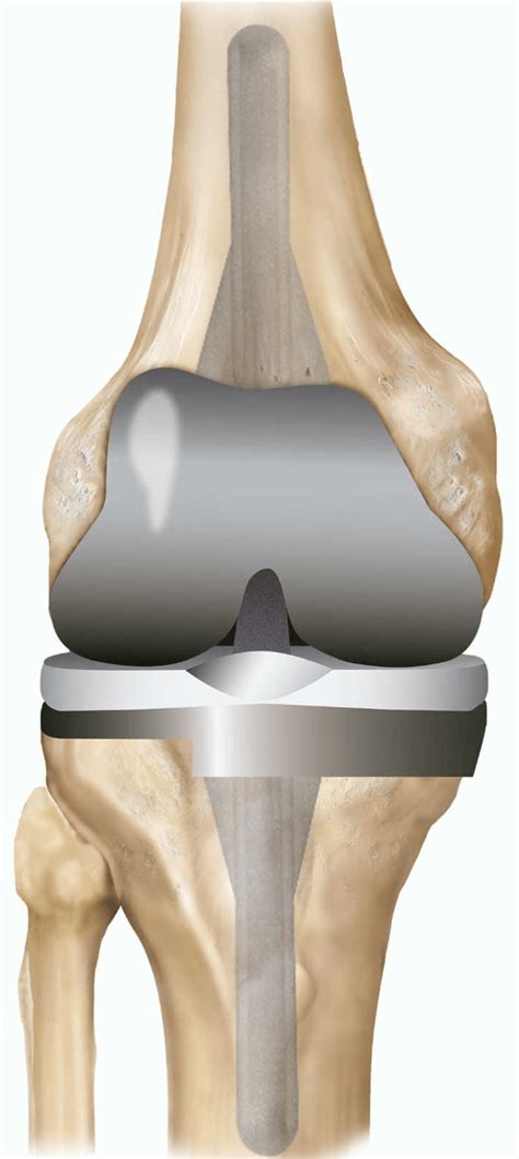 Osteoarthritis Knee Replacement