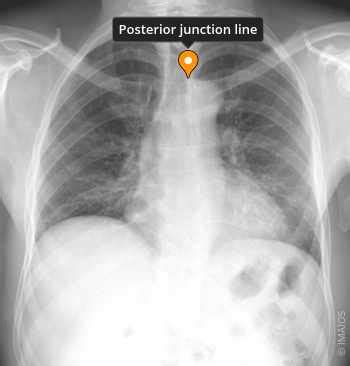 Posterior junction line - e-Anatomy - IMAIOS