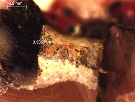 Inter Radicular Perforation Filled With Material Based On Calcium