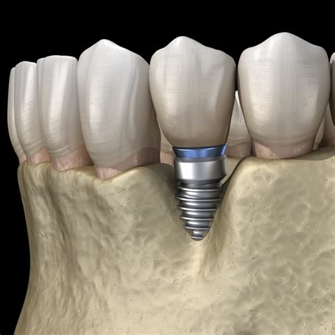 Implant Dentist in Marietta OH | Osseointegration | Dr. Jeff Lee