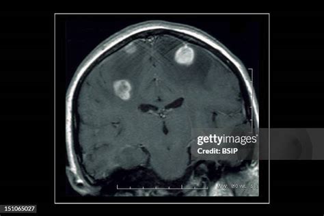 112 Epilepsy Mri Stock Photos, High-Res Pictures, and Images - Getty Images