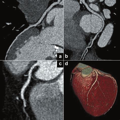 Normal Coronary Arteries A Left Anterior Descending Artery B