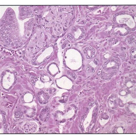 Atrophic Appearing Malignant Glands Are Admixed With Prostatic Download Scientific Diagram