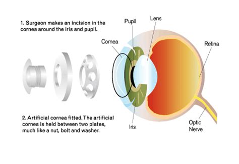 Eye Transplant For Blind Home Design Ideas