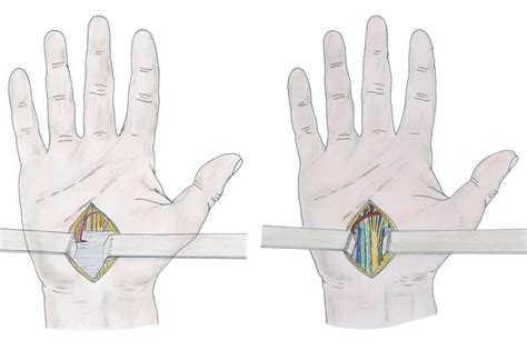 Syndrome Du Canal Carpien Vs Tendinite Tendinite Poignet Okgo Net