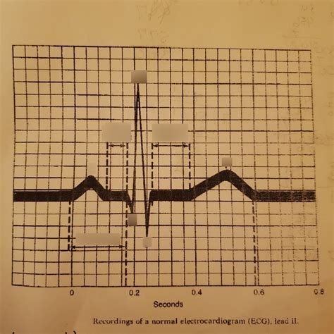 Ecg Diagram Quizlet