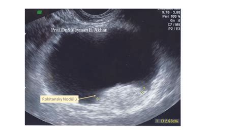 How Dermoid Cysts Are Formed Dermoid Cysts Formation Symptoms