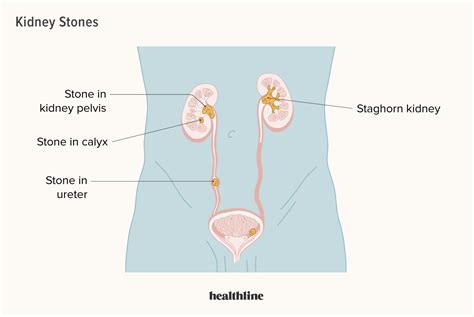 Hydronephrosis causes symptoms and diagnosis – Artofit