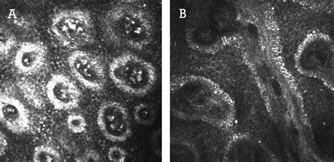 Meibomianitis. (A and B) Meibomian glands with meibomianitis, with high ...