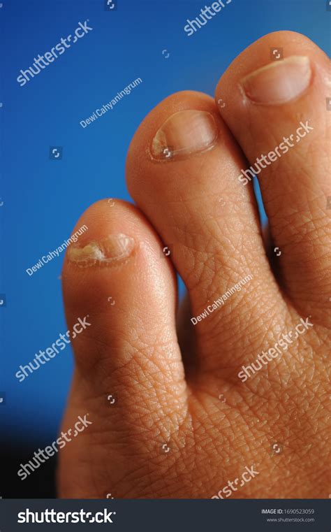 Broken Toenail