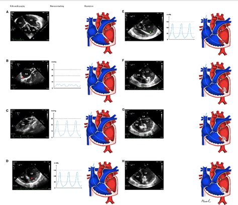 Figure 1 From Transesophageal Echocardiography Guided Percutaneous