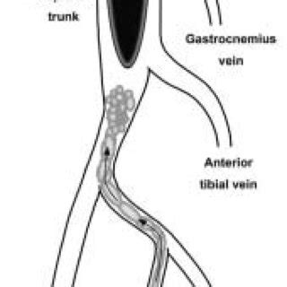 Propagation flow chart of deep vein thrombosis from soleal vein to ...