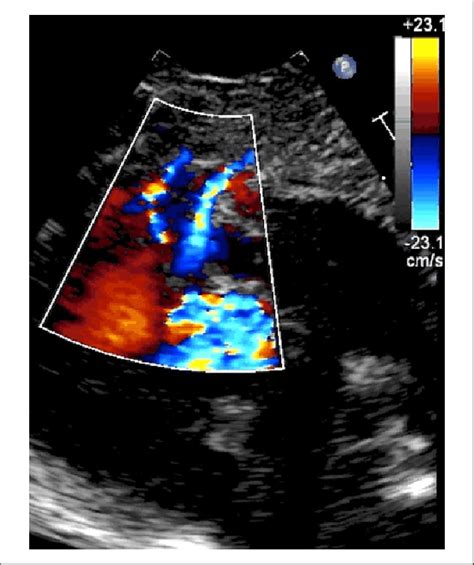 Parasternal Short Axis Color Doppler Echocardiographic View In An Download Scientific Diagram