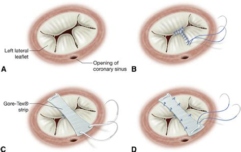 A, Common atrioventricular valve anatomy, surgical view. B, The ...