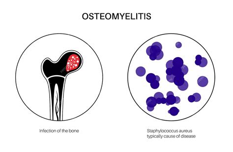 Enfermedad De Osteomielitis Dolor De Cadera Infectado Y Enrojecimiento