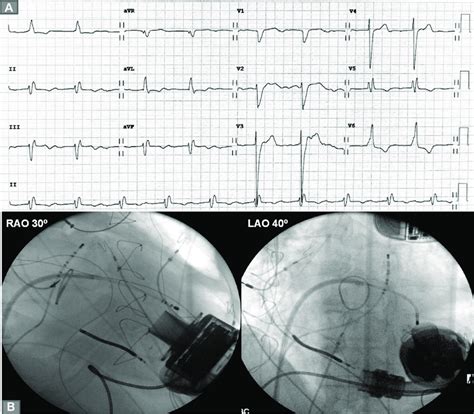 A Twelve Lead Electrocardiogram During Sinus Rhythm Before Left